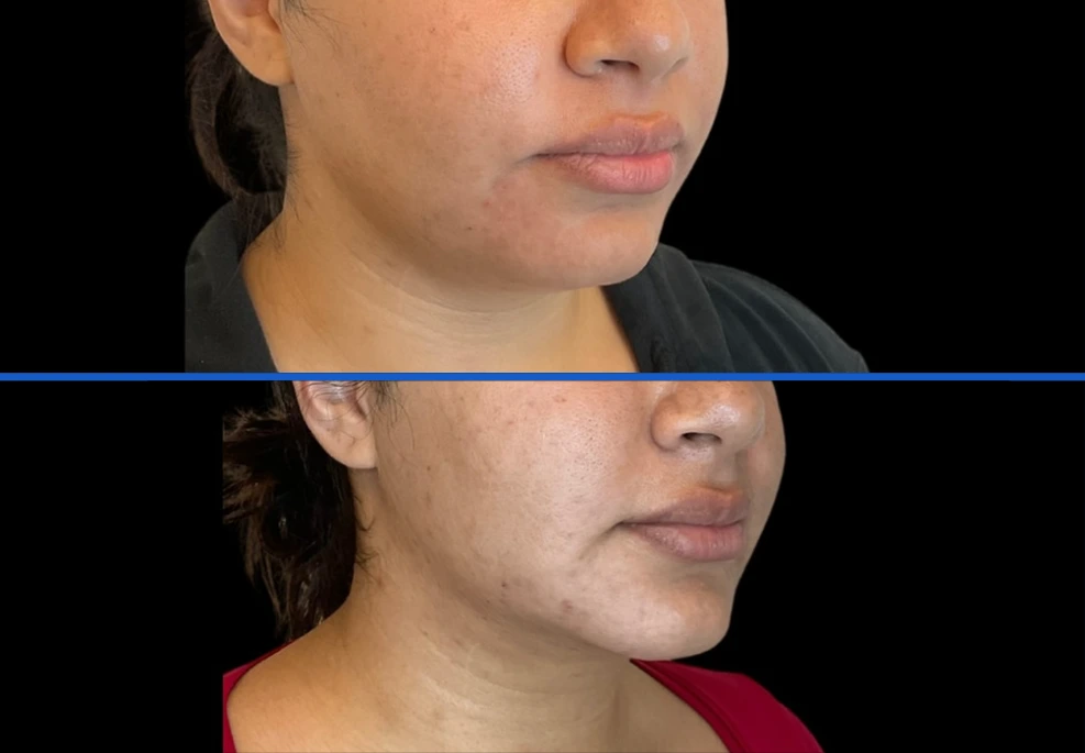 chin1|Exert Clinic