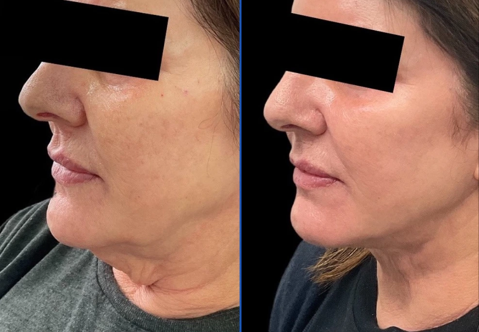 chin19| Exert Clinic