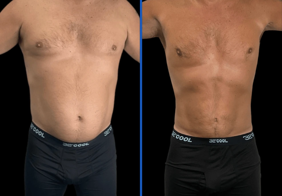 flanks-1|Exert Clinic