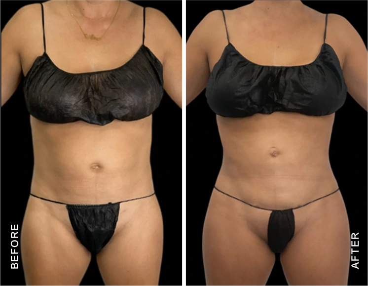 Abdomen Liposuction Before & After Banner