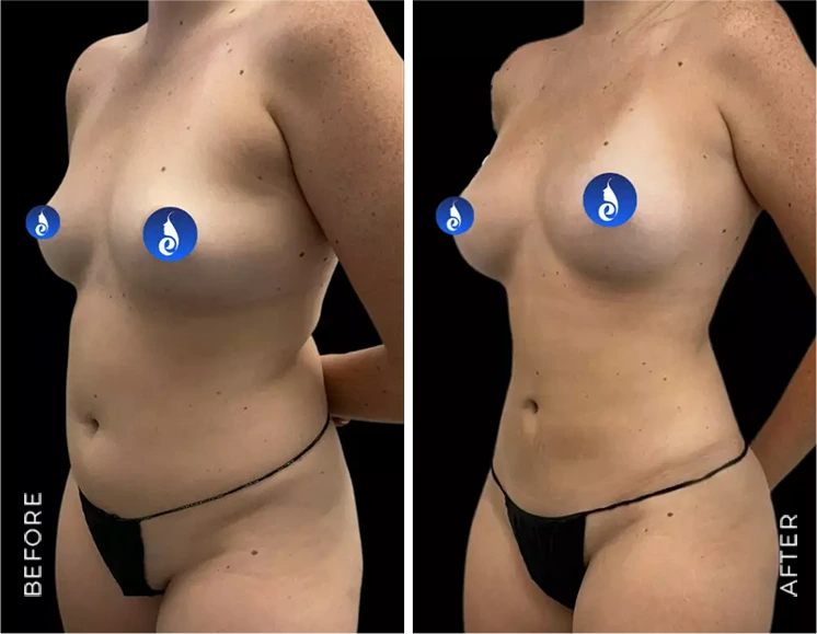 Fat Transfer Breast Before & after banner