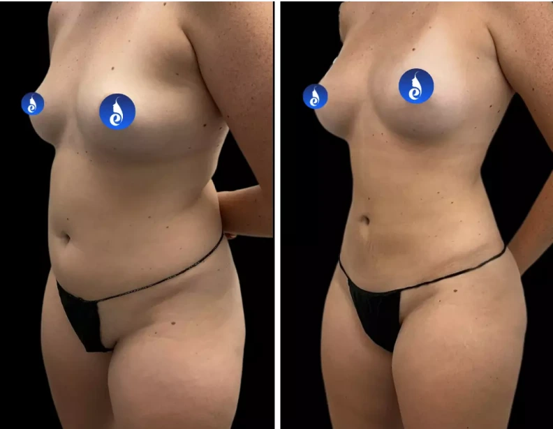 Lipo 360 Before and after