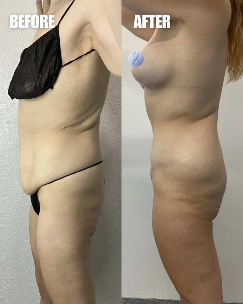 Weight Loss