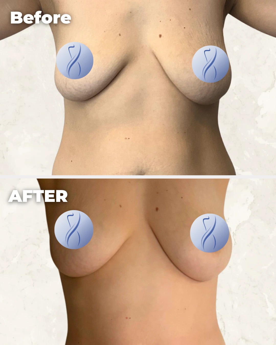 Before and after comparison of breast augmentation results showing increased volume and fullness