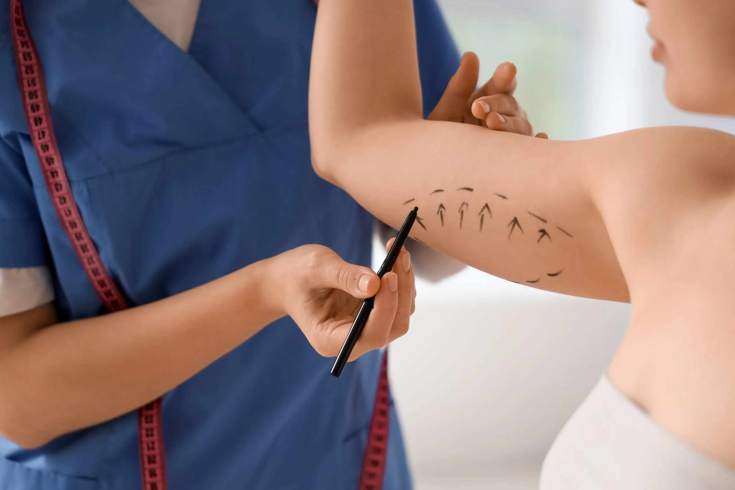Cosmetic surgeon marking a patient's arm before a liposuction procedure
