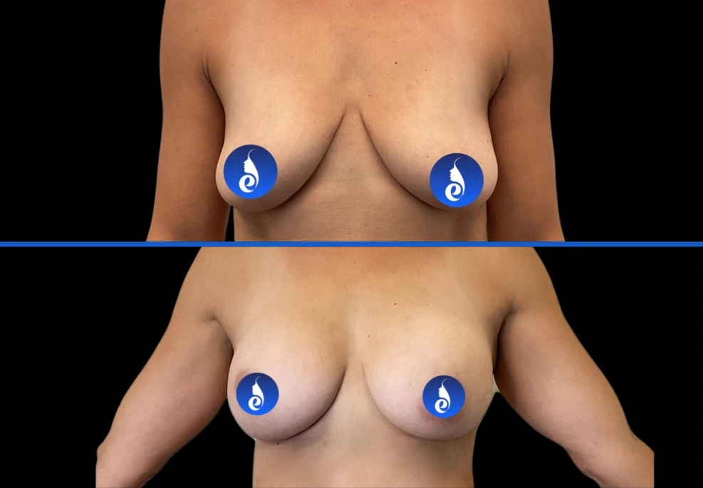 Breast| Exert Clinic