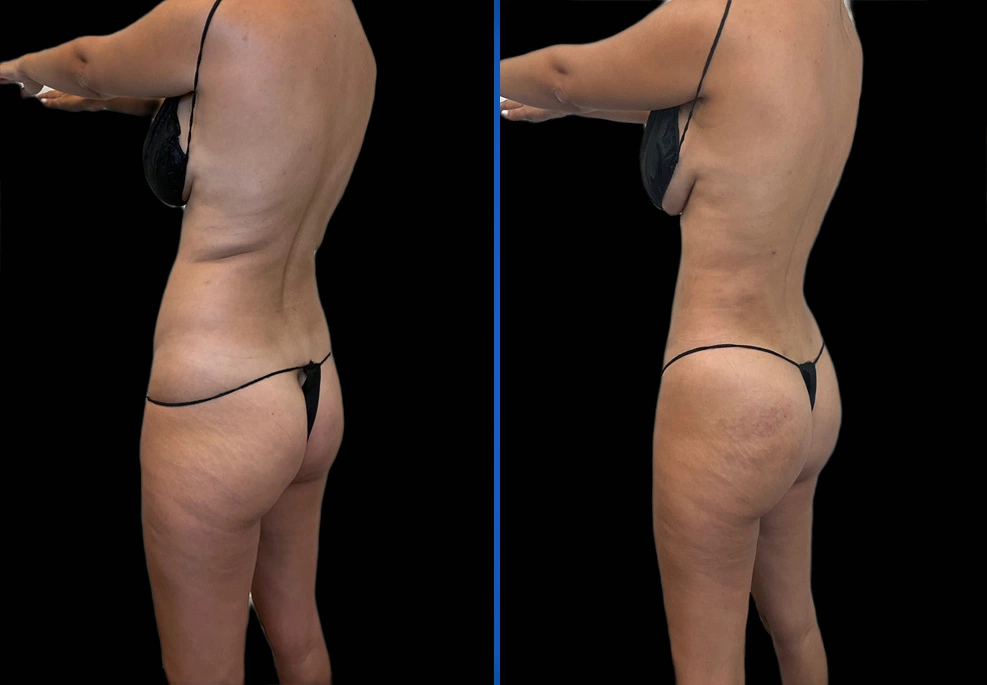 Case-0006-oblique|Exert Clinic