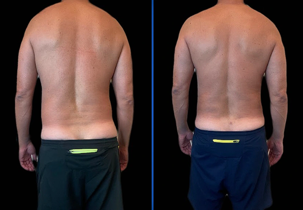 Case-0009-Back|Exert Clinic