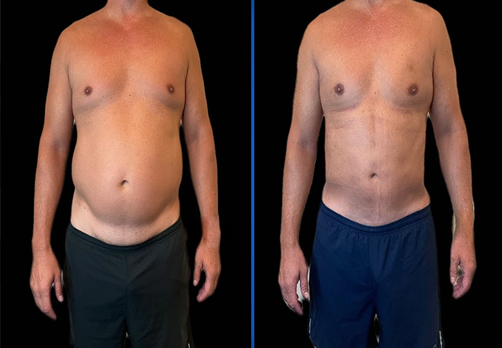 Case-0009-Front.|Exert Clinic