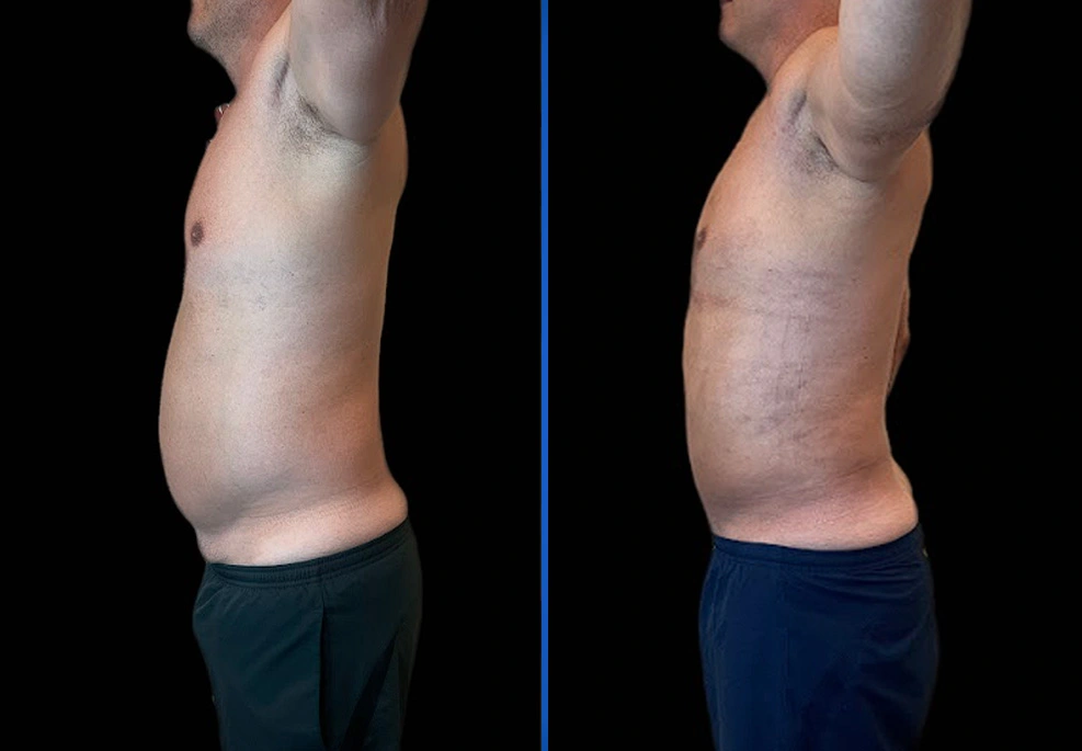 Case-0009-side|Exert Clinic