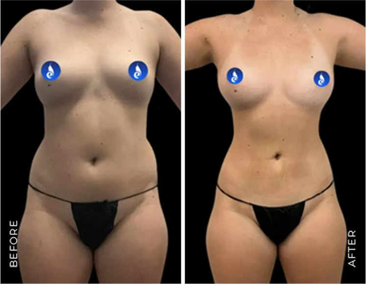 abdomin liposuction before & after