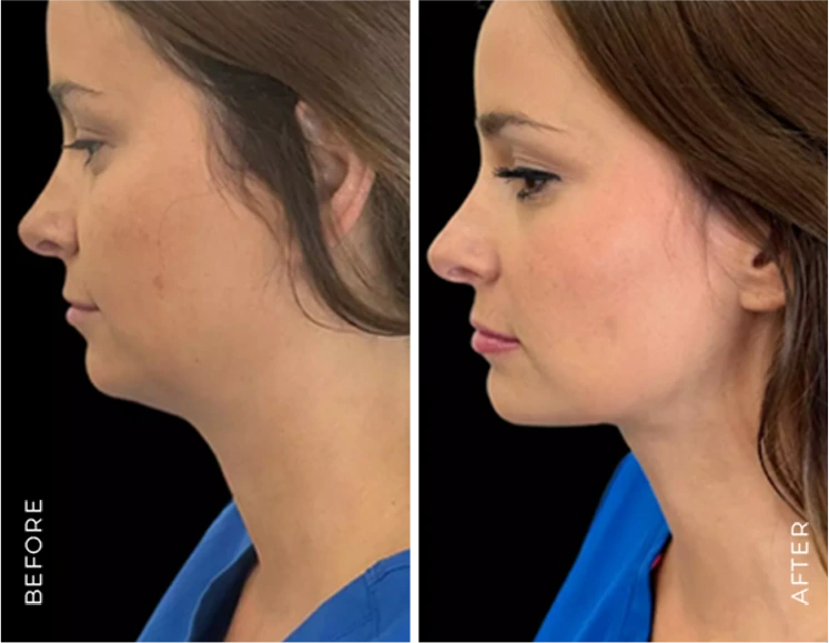 Chin Linposuction before & After Banner