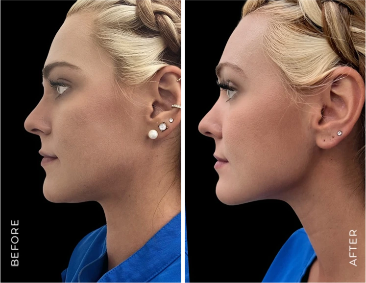 Chin liposuction before & after
