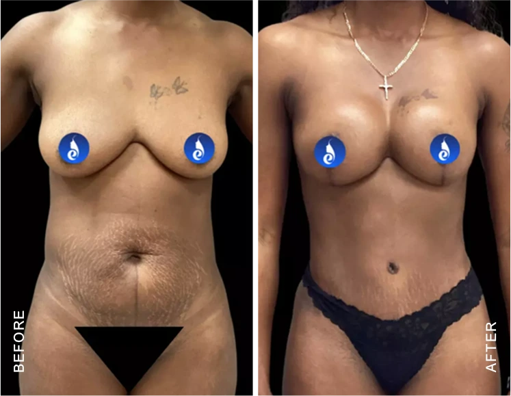 Mommy Makeover Before & After Banner