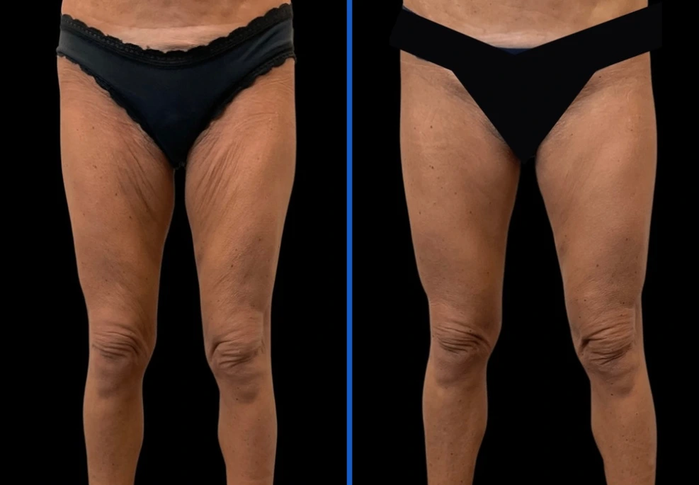 thighxpress4|ExertClinic