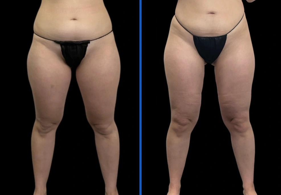 thighxpress5|Exert Clinic