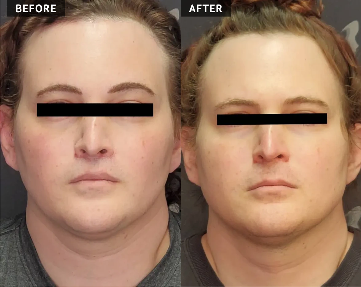Before & After Facial Masculinization