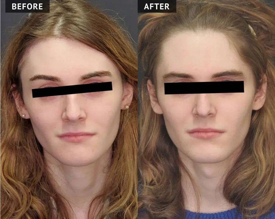 Before & After Facial Masculinization