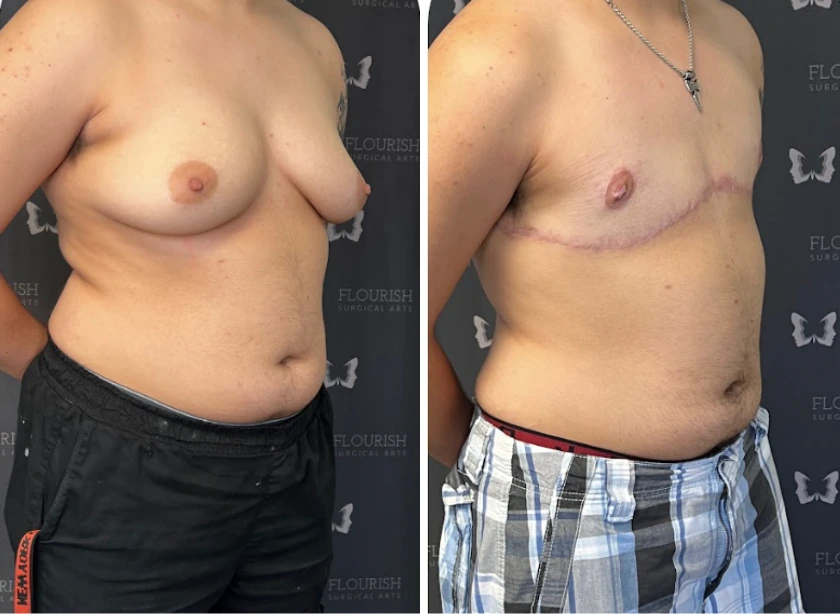 Top Sx With Free Nipple Graft - Case 1 (2)
