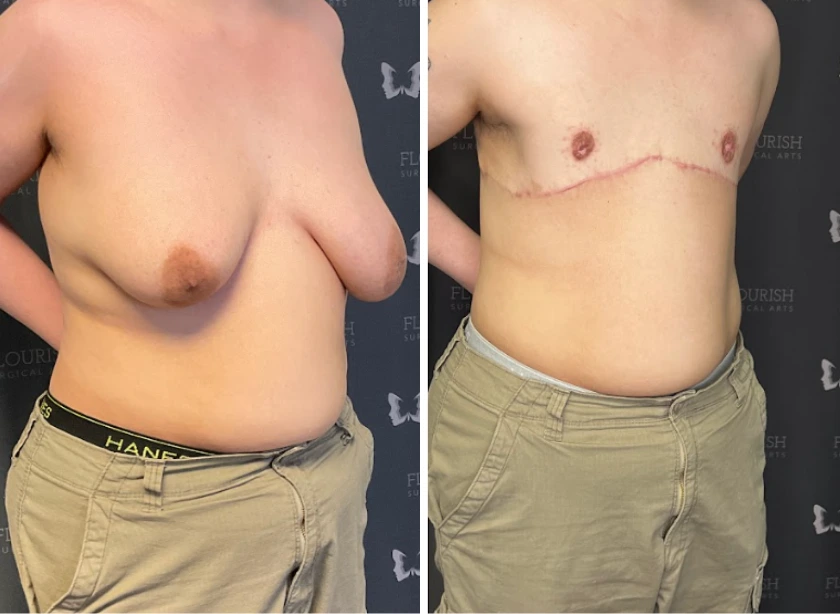 Top Sx With Free Nipple Graft - Case 2 (3)