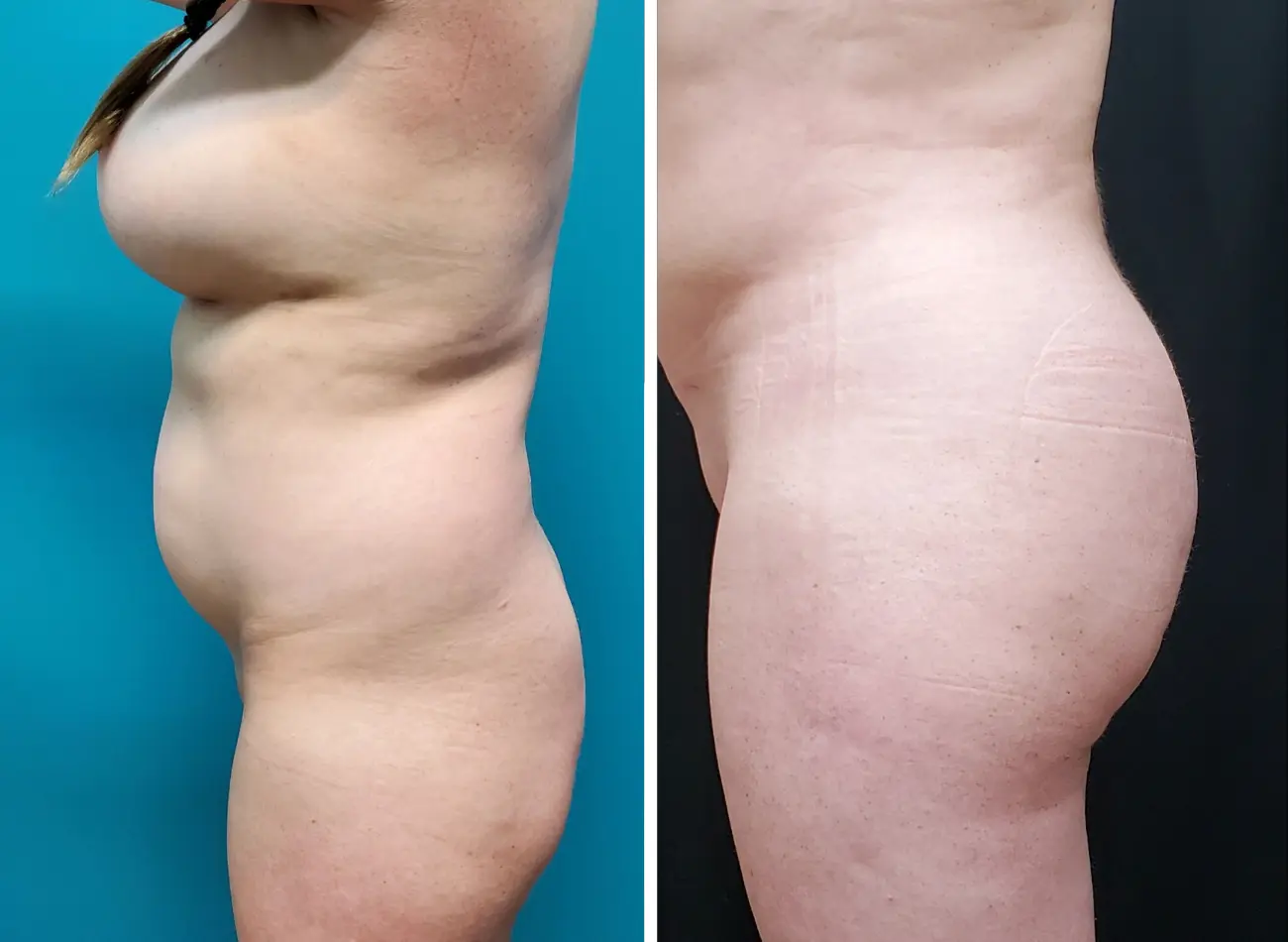 Before and After Gallery: BBL Banner