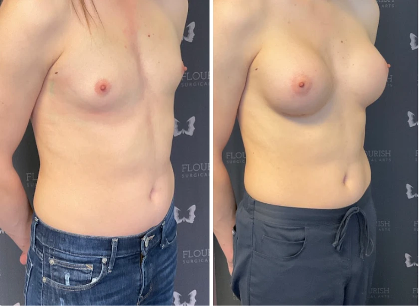 Before and After Gallery: Breast Lift