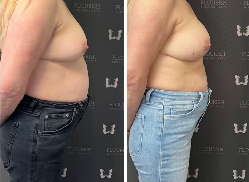 Breast Aug with Lift - Case 3 (2)