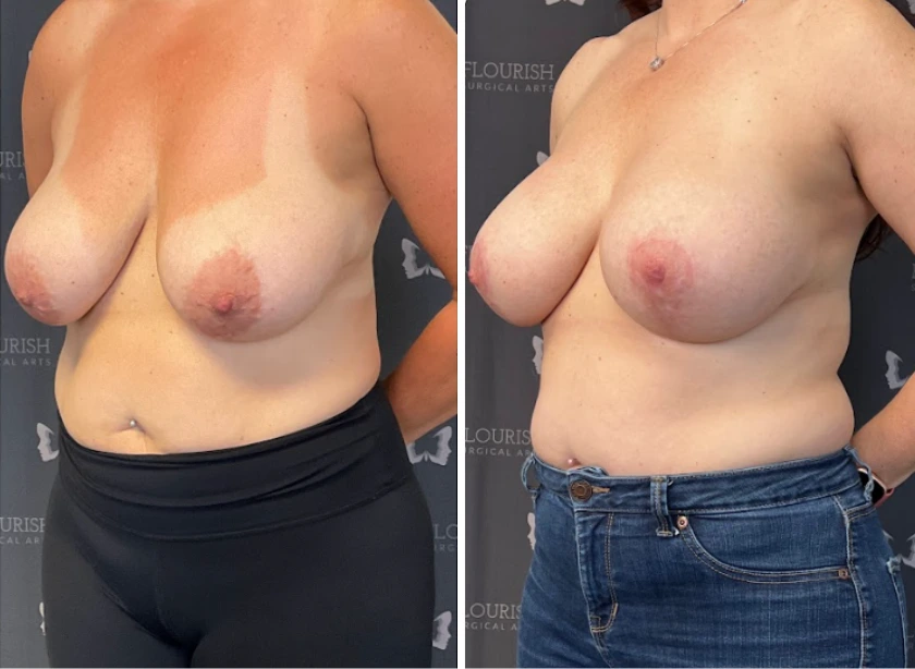 Breast Aug with Lift - Case 4 (2)