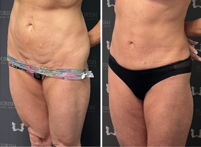 Mini Tummy Tuck