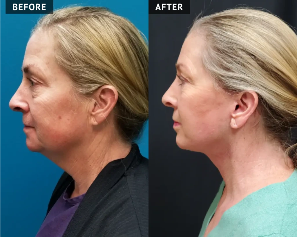 Neck Lift Before & After Banner
