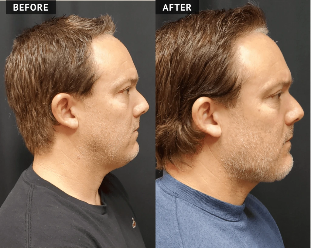 Neck Lift Before & After Banner