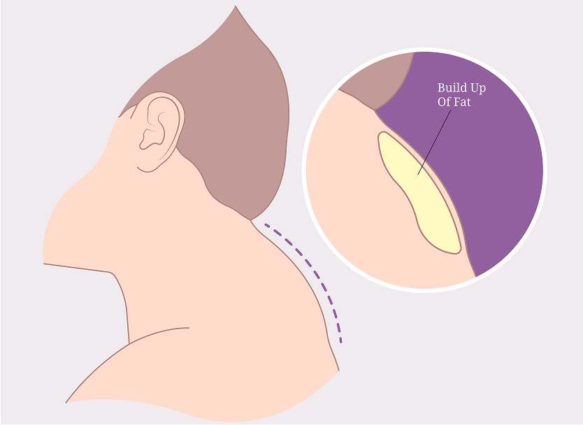 What Is a Buffalo Hump Denver, CO Banner