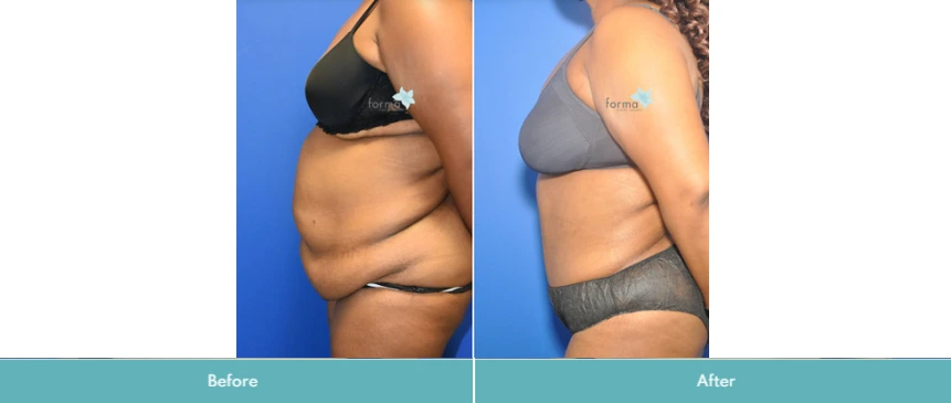 Abdominoplasty (Tummy Tuck) (9)
