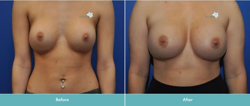 Breast Implant Exchange (7)