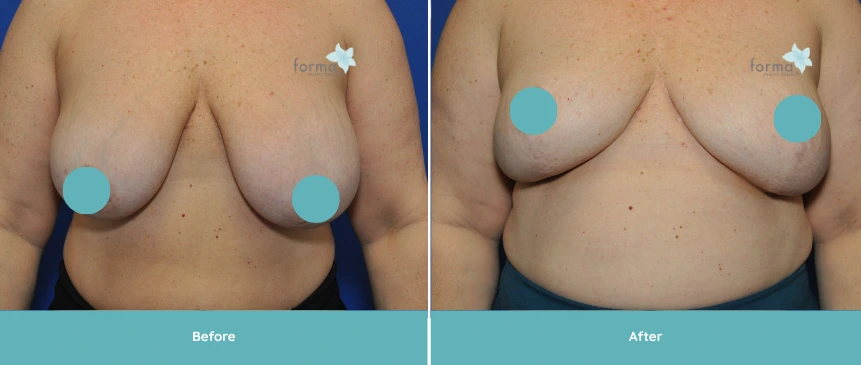 Before and after breast reduction by Dr. Sabeeh, showing reduced breast size and improved contour