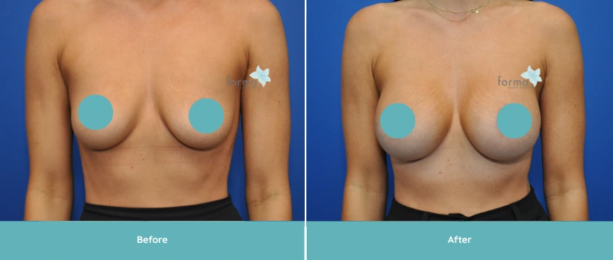Dr. Walsh breast augmentation before and after result, frontal view