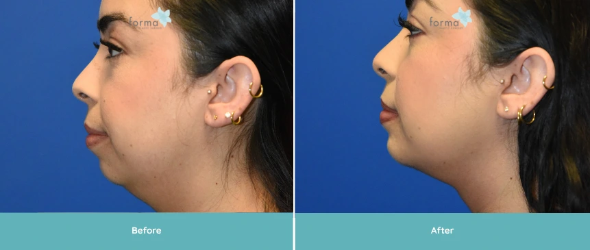 Before chin implant: patient profile showing recessed chin
