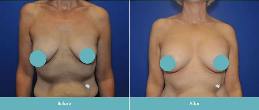Before and after breast augmentation, frontal view