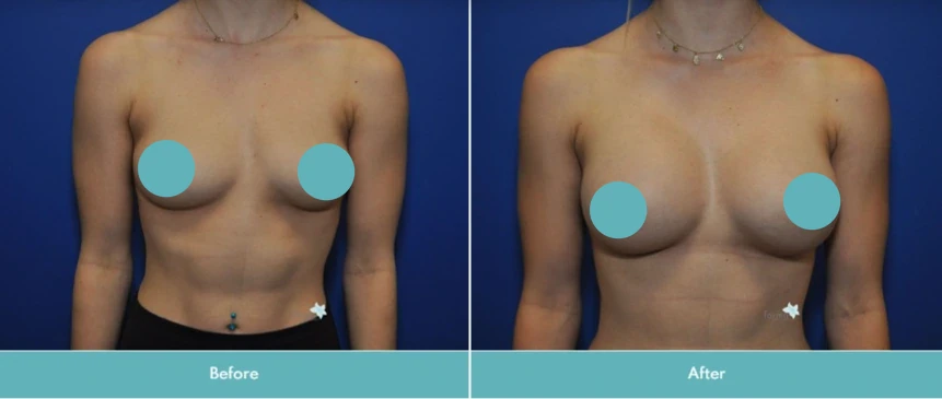 Before and after breast augmentation, frontal view