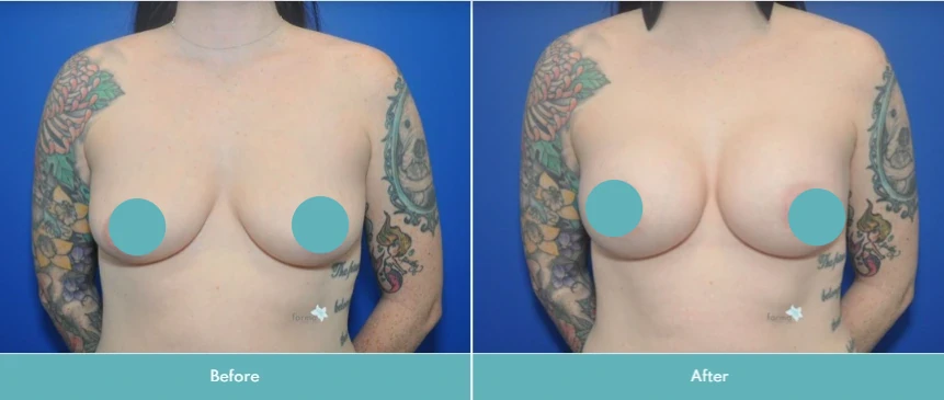 Before and after breast augmentation, frontal view, patient with arm tattoos