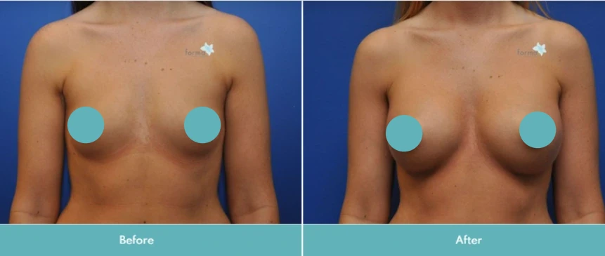 Breast augmentation before and after comparison, frontal view