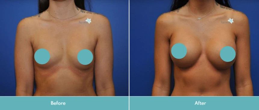 Before and after breast augmentation, frontal view