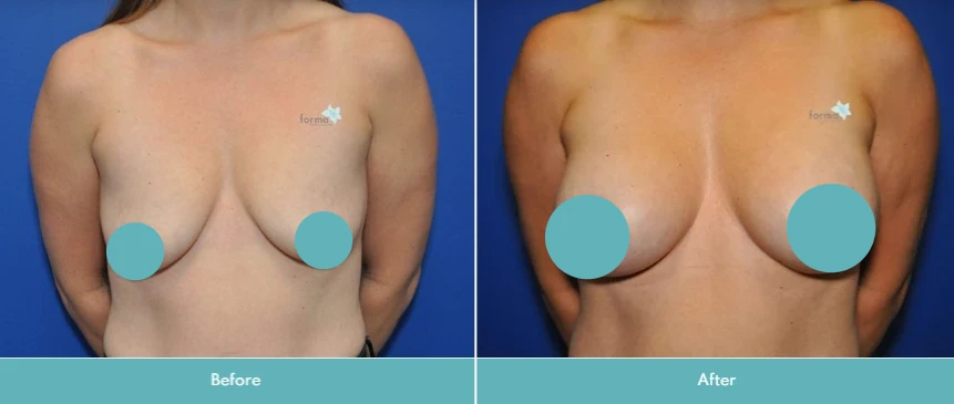 Breast augmentation with lift before and after comparison, frontal view