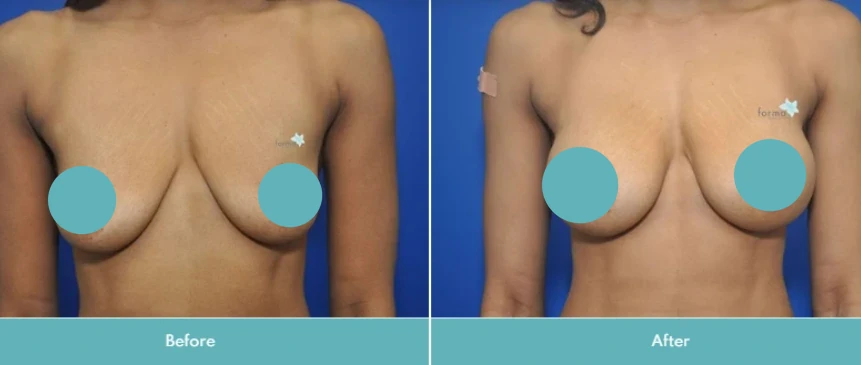 Breast augmentation with lift before and after comparison, frontal view