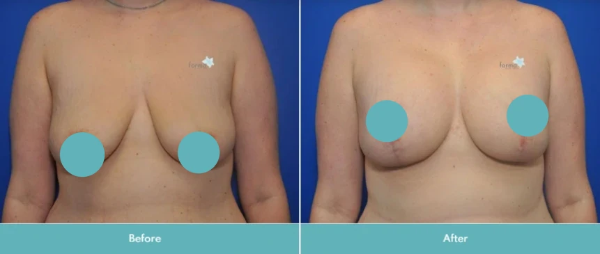 Breast augmentation with lift before and after comparison, frontal view