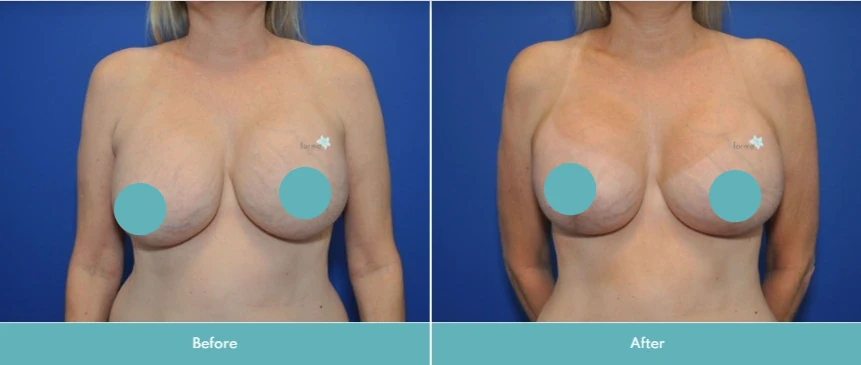 Breast augmentation before and after comparison, frontal view