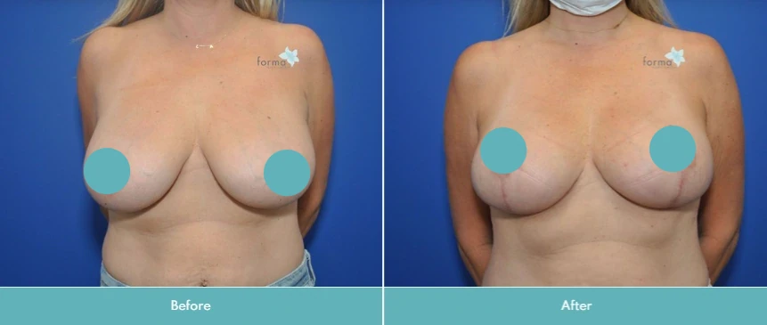 Breast augmentation before and after comparison, frontal view