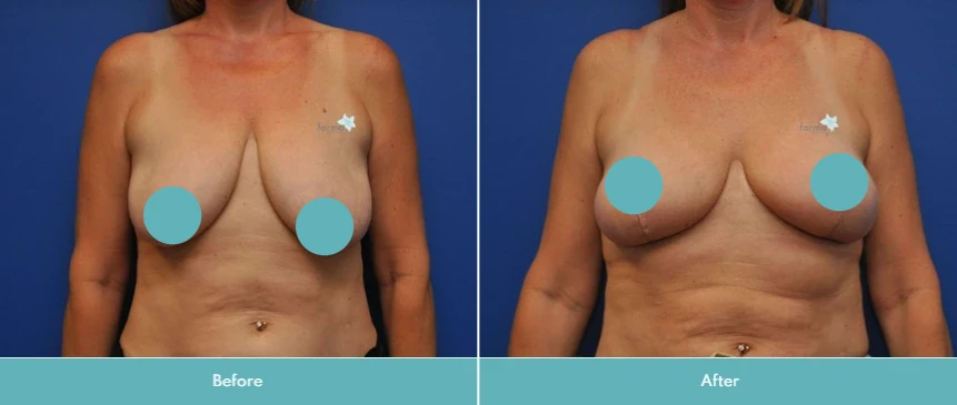 Before and after breast lift surgery showing improved lift and breast profile