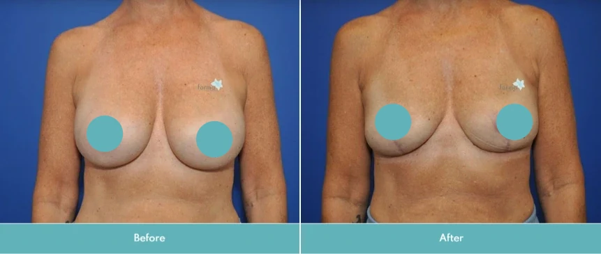 Before and after breast lift surgery showing refined shape and repositioning