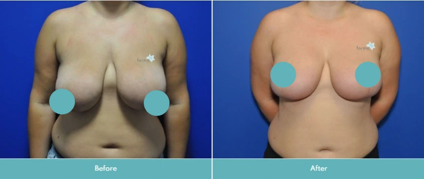 Breast augmentation before and after comparison, frontal view